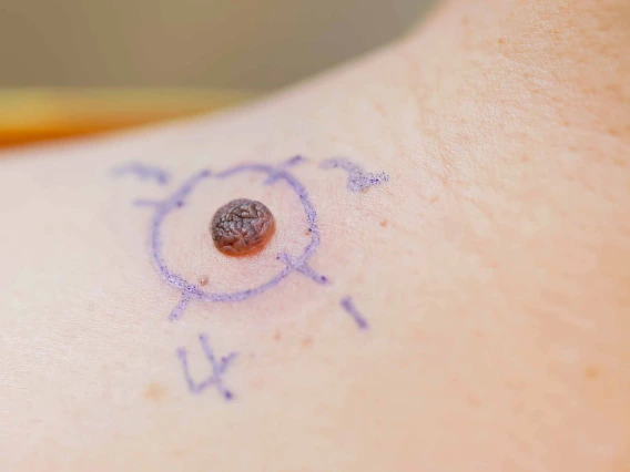 Mole with cirle around it and numbered 1 to 4